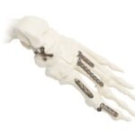 MONOLOC EXTREMITIES LOCKING COMPRESSION PLATE SYSTEM-trauma-supplies-Cameroon