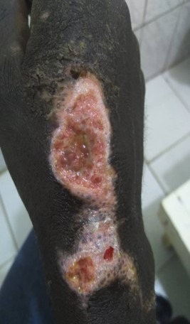 chronic wound management- cameroon - medical supplies