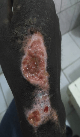 chronic wound management- cameroon - medical supplies