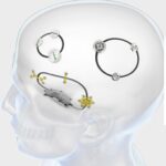 Neuro-Plating-System supplies Cameroon